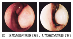 花粉症とは 花粉症 ドクター S コラム Eo健康