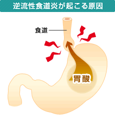 チェックシート 逆流性食道炎 ドクター S コラム Eo健康